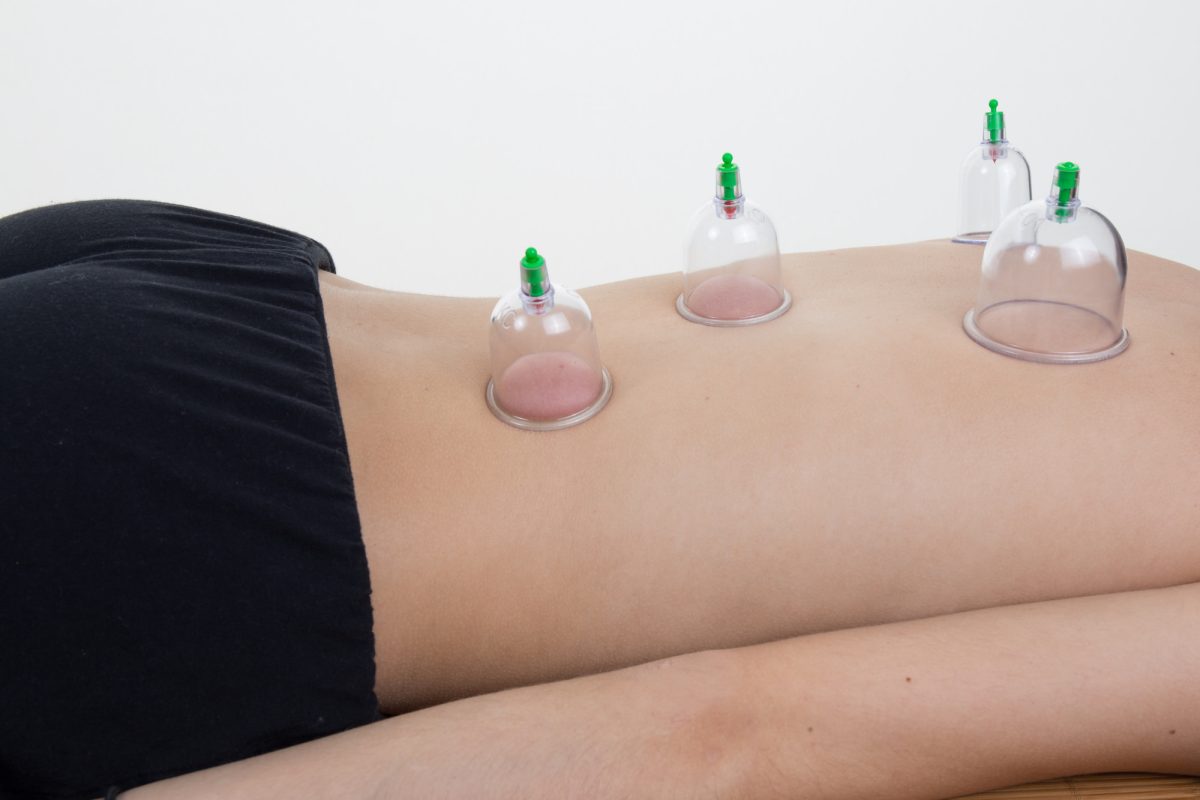 View of therapist giving cupping therapy to Woman